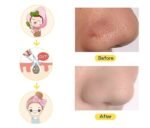 ✨ Electric Blackhead Remover Vacuum – Deep Pore Cleaner & Acne Removal Device - Image 3